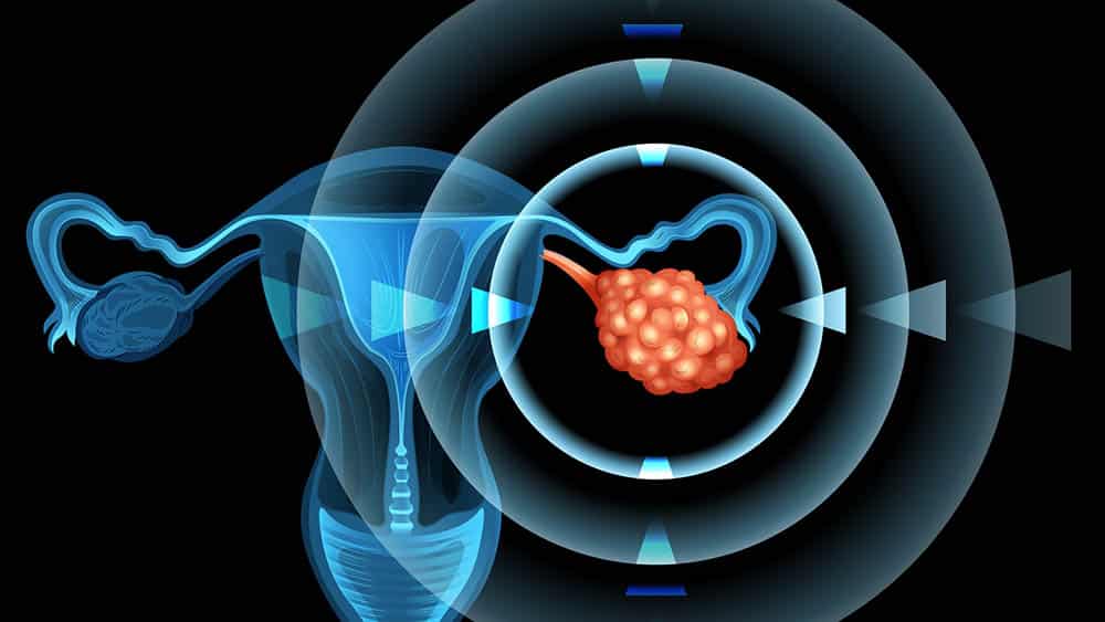 O que é a síndrome do ovário policístico?