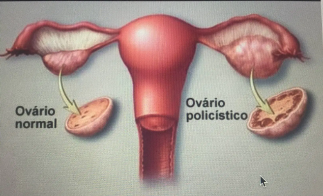 Cístos no ovário-Sintomas e causas