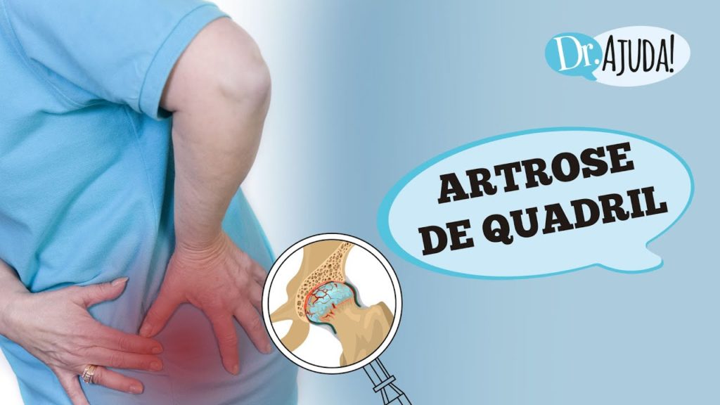 ARTROSE DE QUADRIL