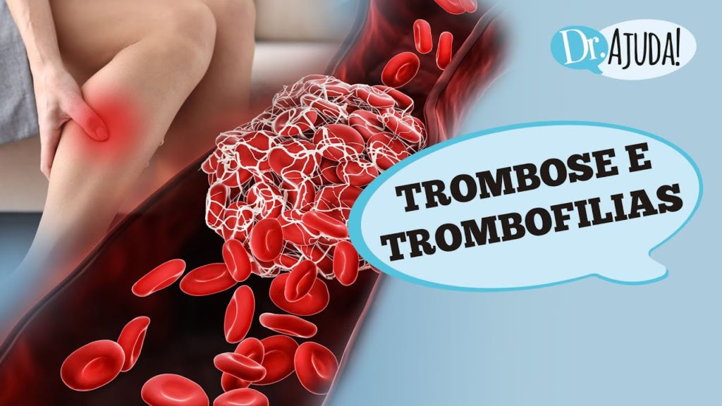 TROMBOSE E TROMBOFILIAS: O que são?